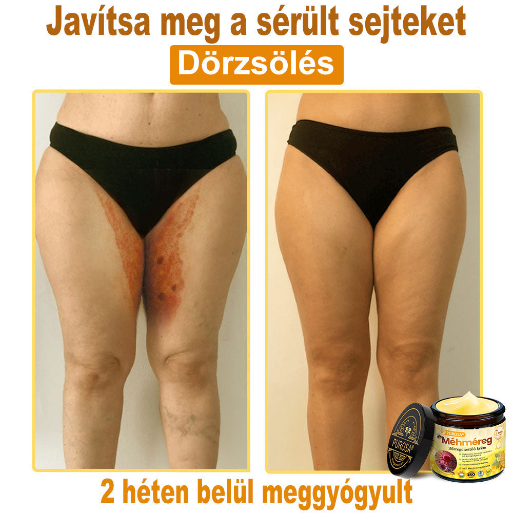 🐝PUROSA® Méhméreg Bőrmegújító Krém|✅Teljes körű megoldás a makacs bőrproblémák, például az öregedés, ekcéma, hegek és pikkelysömör ellen