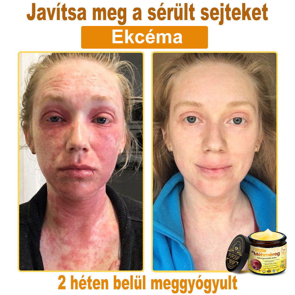 🐝PUROSA® Méhméreg Bőrmegújító Krém|✅Teljes körű megoldás a makacs bőrproblémák, például az öregedés, ekcéma, hegek és pikkelysömör ellen