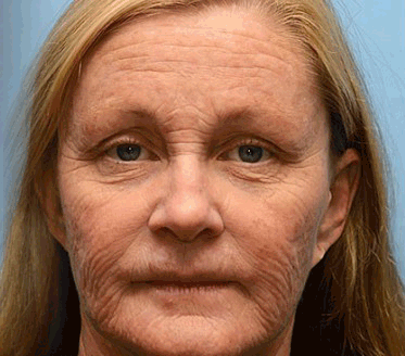 🐝PUROSA® Méhméreg Bőrmegújító Krém|✅Teljes körű megoldás a makacs bőrproblémák, például az öregedés, ekcéma, hegek és pikkelysömör ellen