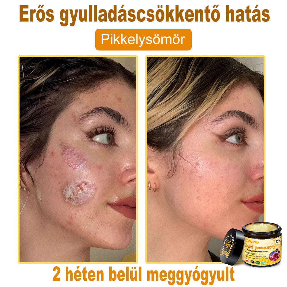 🐝PUROSA® Méhméreg Bőrmegújító Krém｜✅Teljes körű megoldás a makacs bőrproblémák, például az öregedés, ekcéma, hegek és pikkelysömör ellen