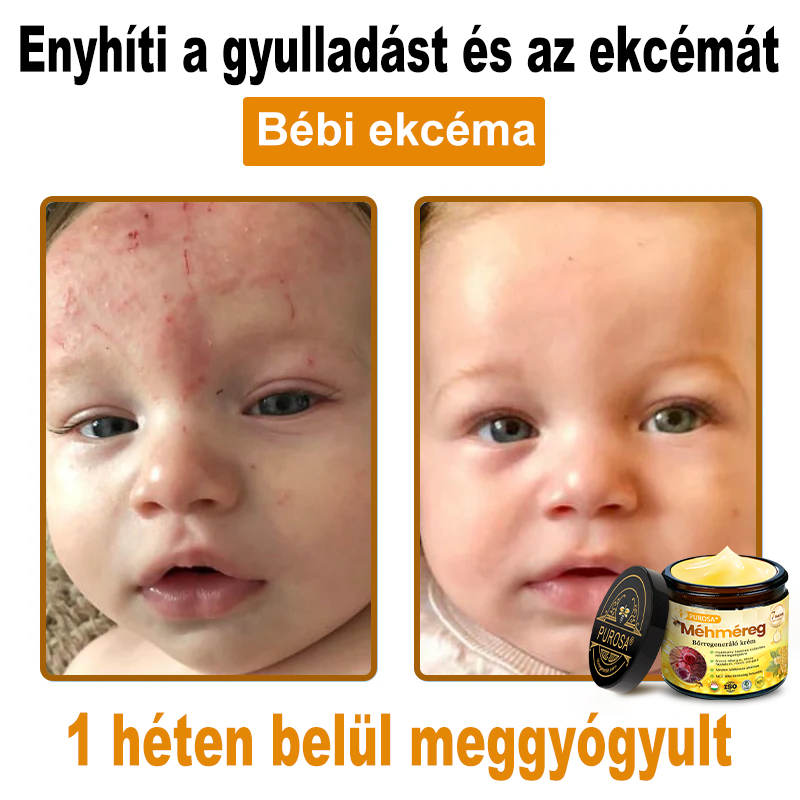 🐝PUROSA® Méhméreg Bőrmegújító Krém｜✅Teljes körű megoldás a makacs bőrproblémák, például az öregedés, ekcéma, hegek és pikkelysömör ellen