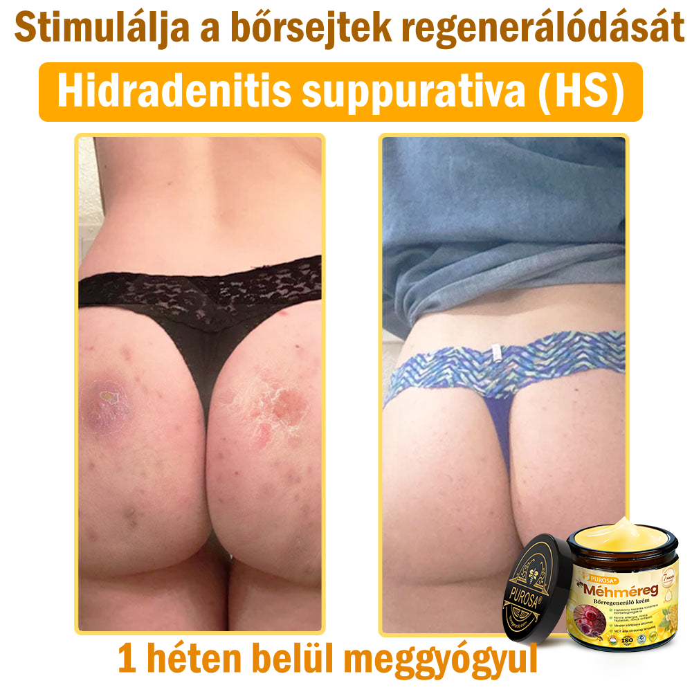 🐝PUROSA® Méhméreg Bőrmegújító Krém｜✅Teljes körű megoldás a makacs bőrproblémák, például az öregedés, ekcéma, hegek és pikkelysömör ellen