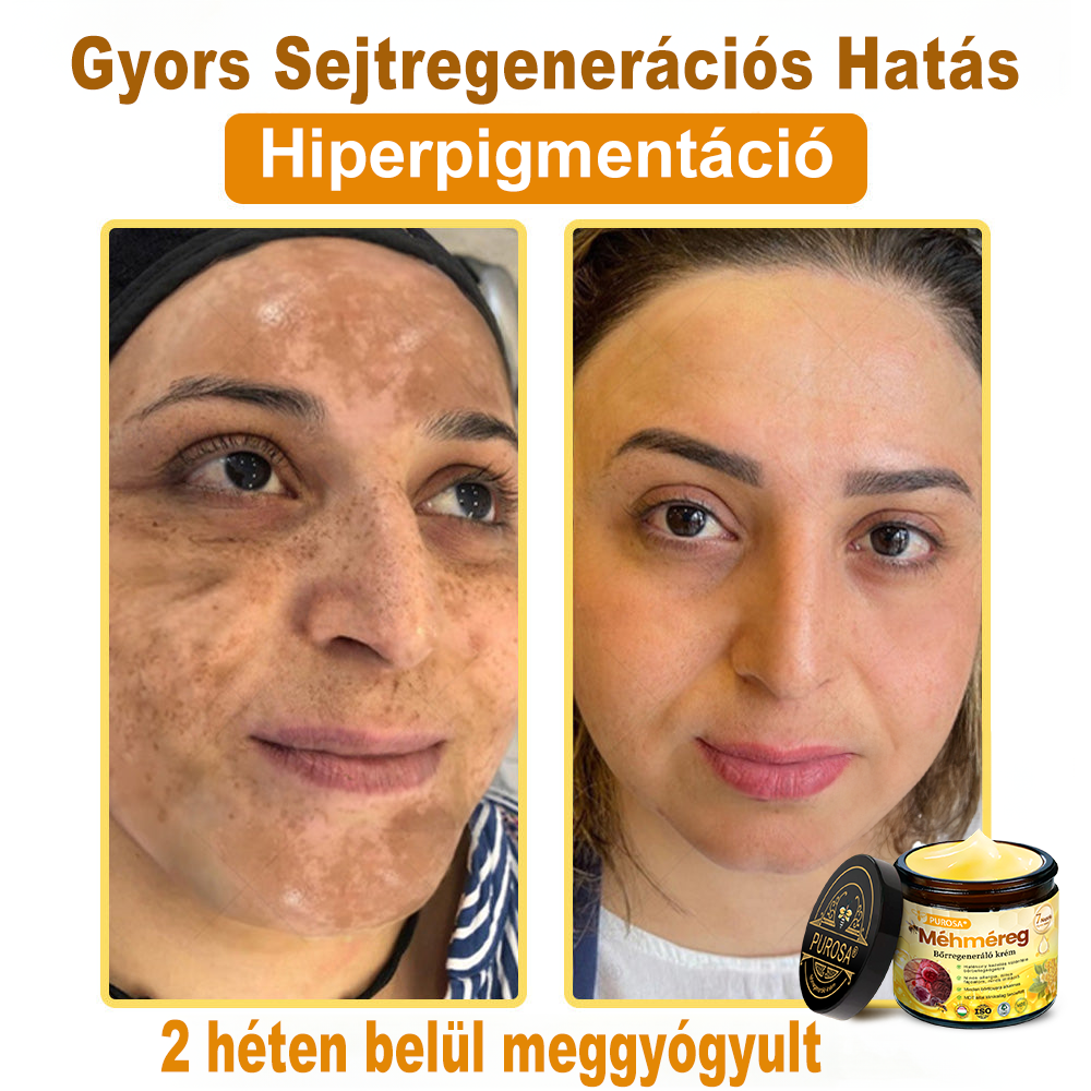 🐝PUROSA® Méhméreg Bőrmegújító Krém｜✅Teljes körű megoldás a makacs bőrproblémák, például az öregedés, ekcéma, hegek és pikkelysömör ellen